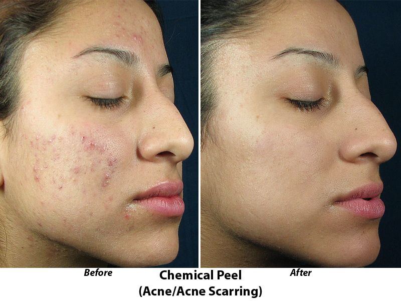 Skin peel acid facial chemical peels
