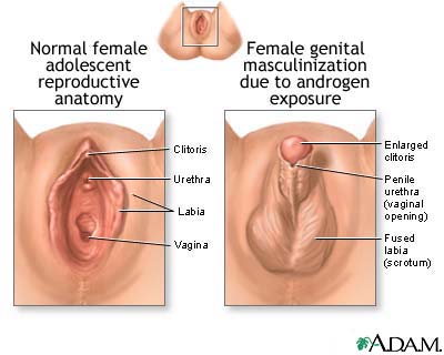 Clitoris enlarged by testonsterone