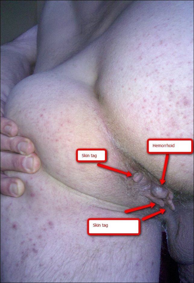 Earth E. reccomend Female anus skin tag pictures
