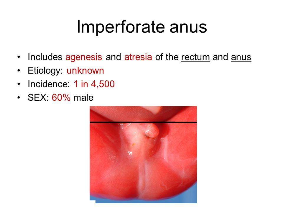 best of Anus for Screen newborns imperforate