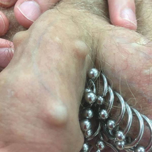 Penis bead inplants