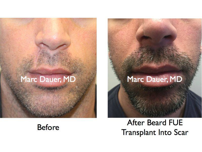best of Miami implants Facial hair
