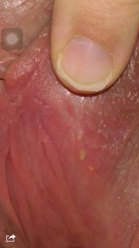Very small hard lump on my vulva