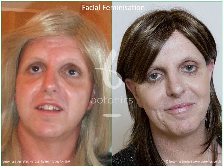 best of Photos Before facial feminization after
