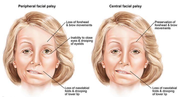 best of And weakness stroke facial Central