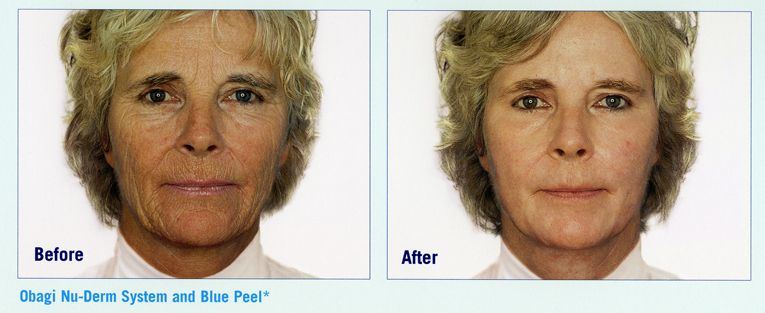 Facial skin tightening jessner peel