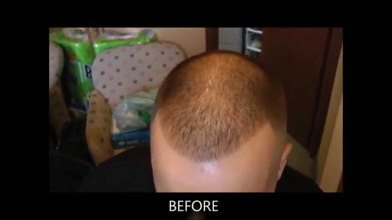 Hair head shaved transplant