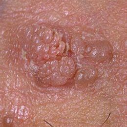 Pictures of genital warts on anus