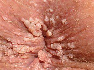 Gunslinger recomended anus genital warts Pictures of on