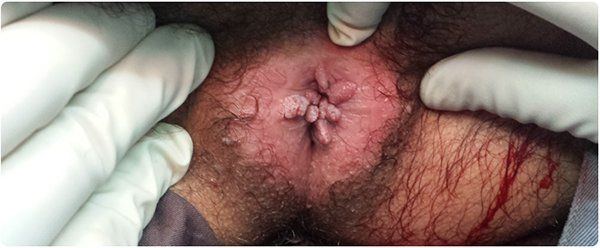 Mayhem reccomend Pictures of genital warts on anus