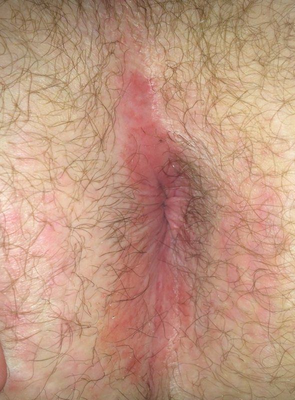 best of Pain Pruritus perineum anal redness