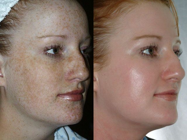Gear B. reccomend Skin peel acid facial chemical peels