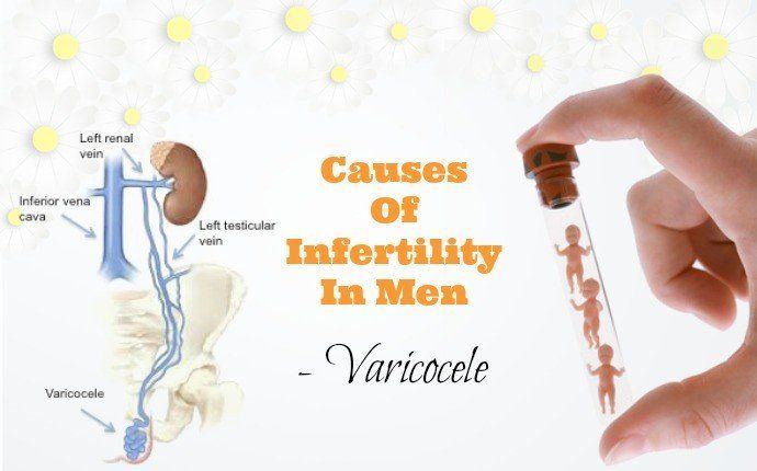 best of Repair sperm Varicocele and