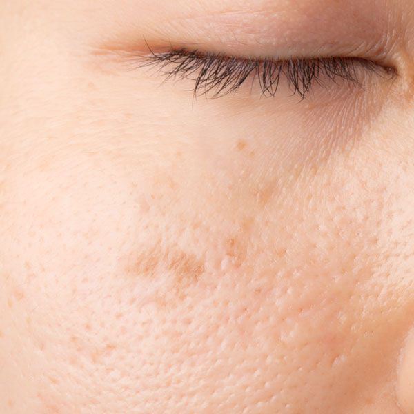 Facial blemish treatments