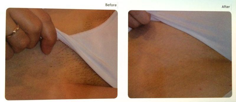 best of Before Bikini after removal hair