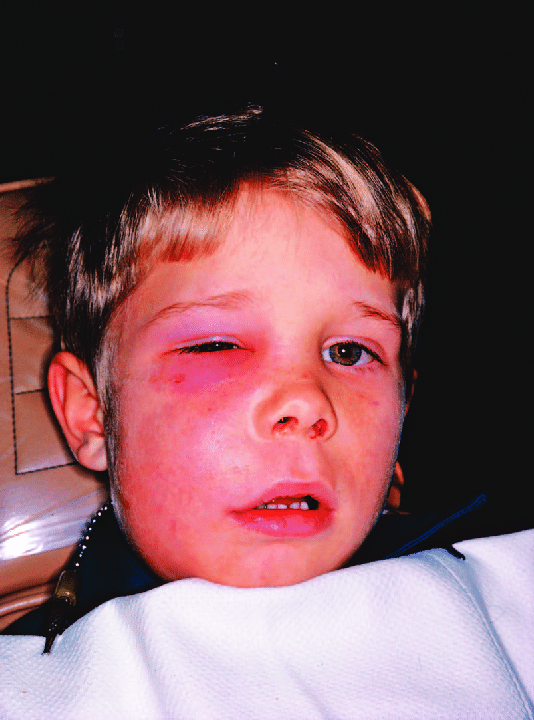best of Images Facial cellulitis
