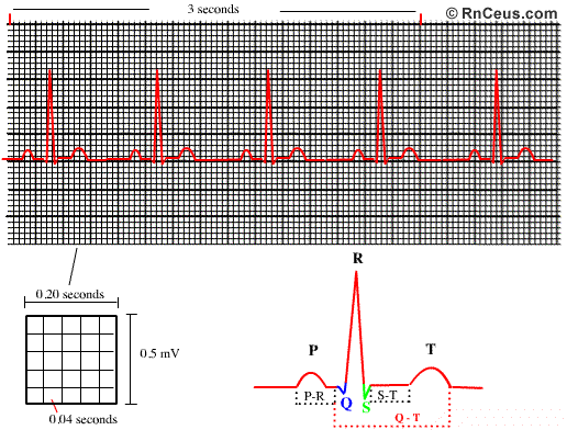 Cardiac rhythm strip analysis