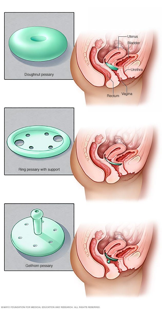 Sixlet recommendet Types of vaginal prolapse