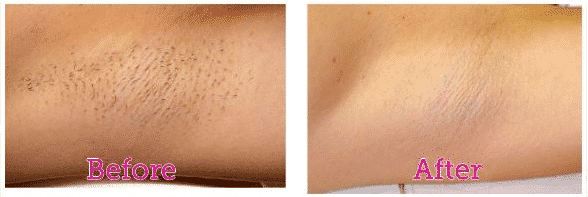 Bikini hair removal before after