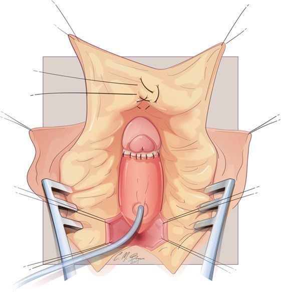 Enlargement of female clitoris