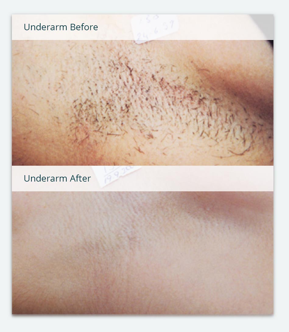 Martian reccomend Bikini hair removal before after