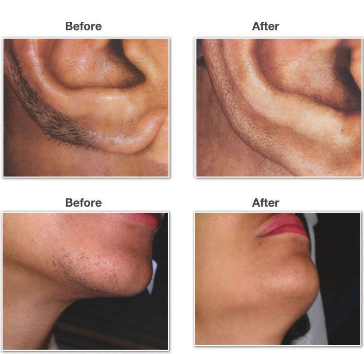 Dallas recommendet Facial hair removal costs