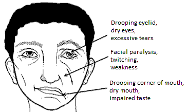 best of Paralysis twitching Facial