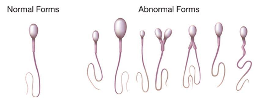 best of Treatment Abnormal sperm