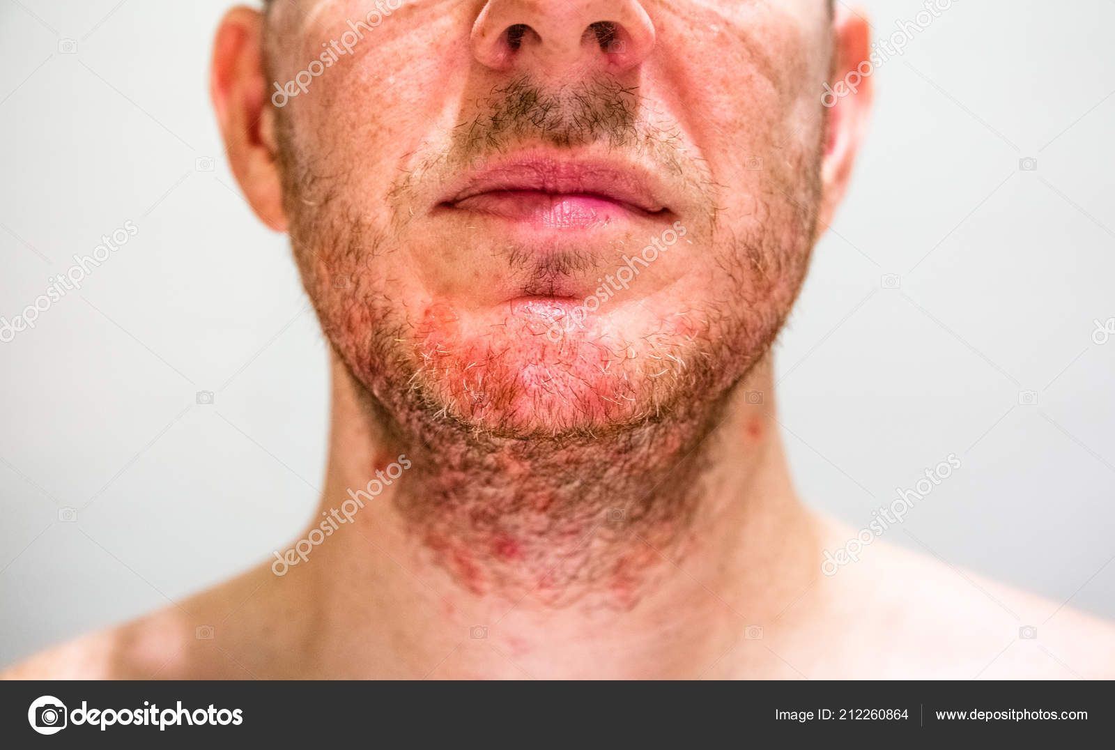 Seborrheic dermatitis face anus Seborrheic Dermatitis