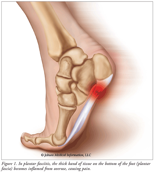 Pain bottom of foot walking
