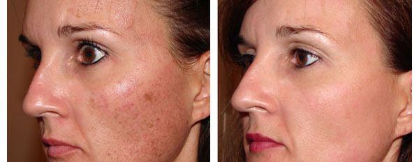 Facial blemish treatments