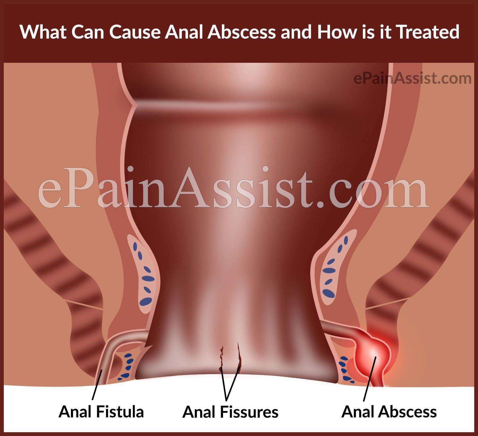 best of On anus in ankle pain Pressure