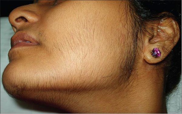 Zee-donk recomended facial regrowth Waxing hair