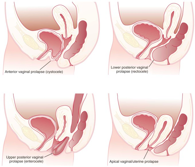 best of Of vaginal prolapse Types