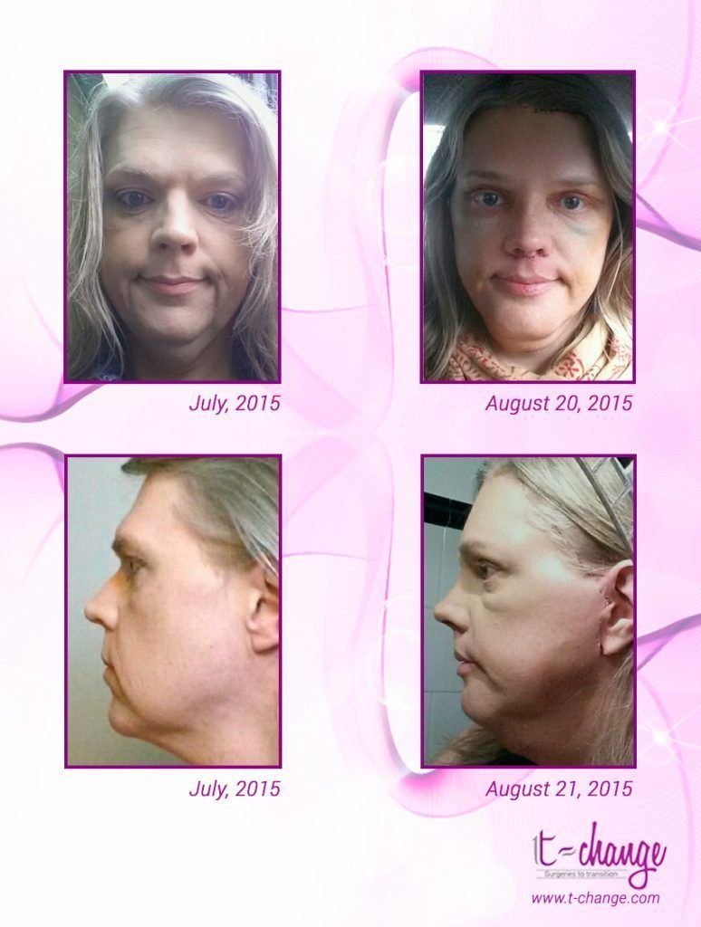 best of Cream Facial feminization
