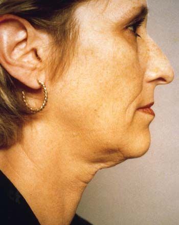 Neck and facial exercises
