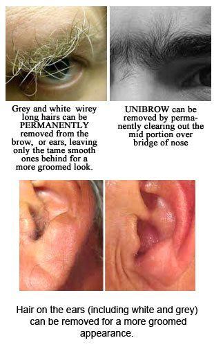 best of Facial hair Electrolysis for mens