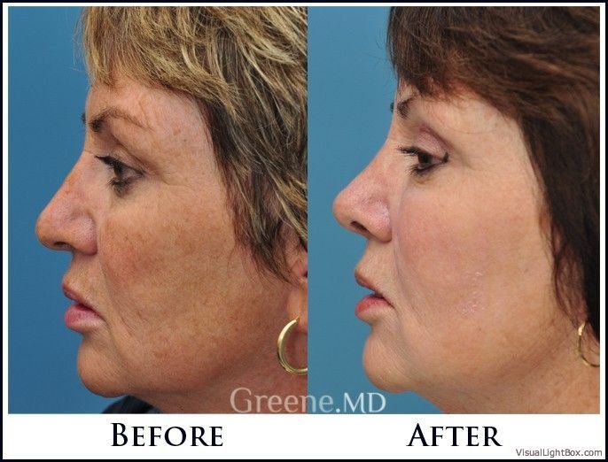 Facial capillary removal miami