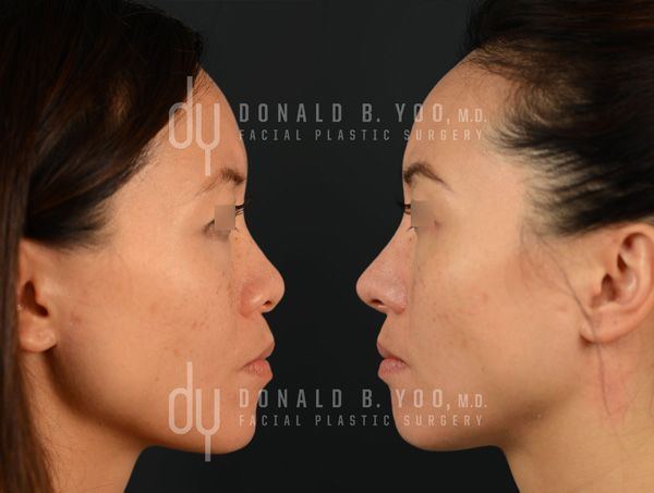 Asian rhinoplasty before and after