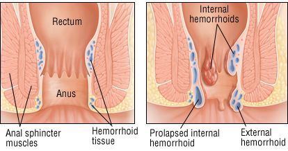 Hermes reccomend Painful bumps near anus