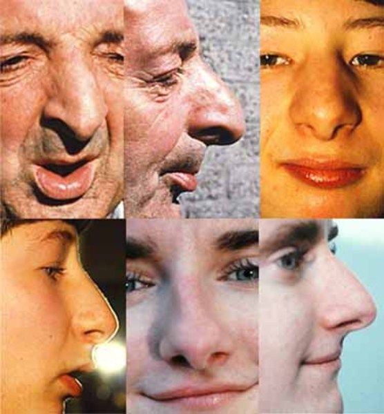 Butterfly reccomend Facial features of syndromes