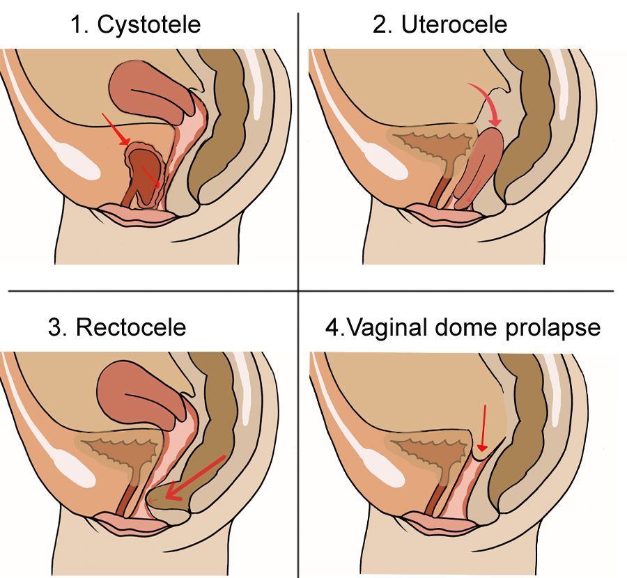 Cosmic reccomend Types of vaginal prolapse