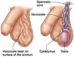 Verices in scrotum and low sperm count