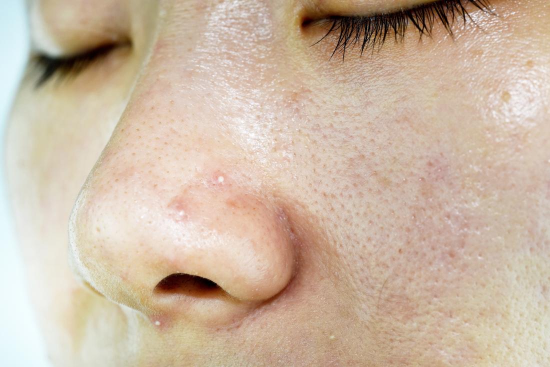 HAL reccomend Skin condition oily scaly facial skin