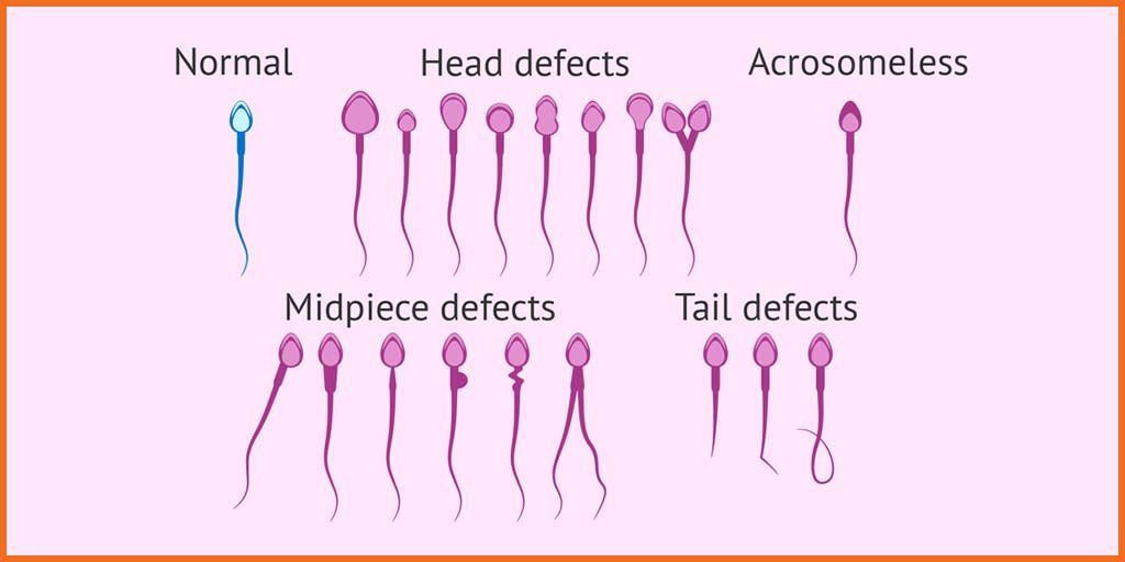 best of Sperm abnormally shaped Figures of