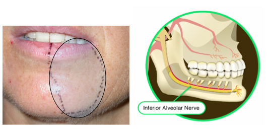 best of Nerve damage peripheral dental Facial