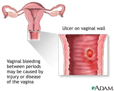 Fuzz reccomend Excessive bleeding in the vagina