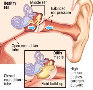 Recruit recommend best of ear adults Double infection