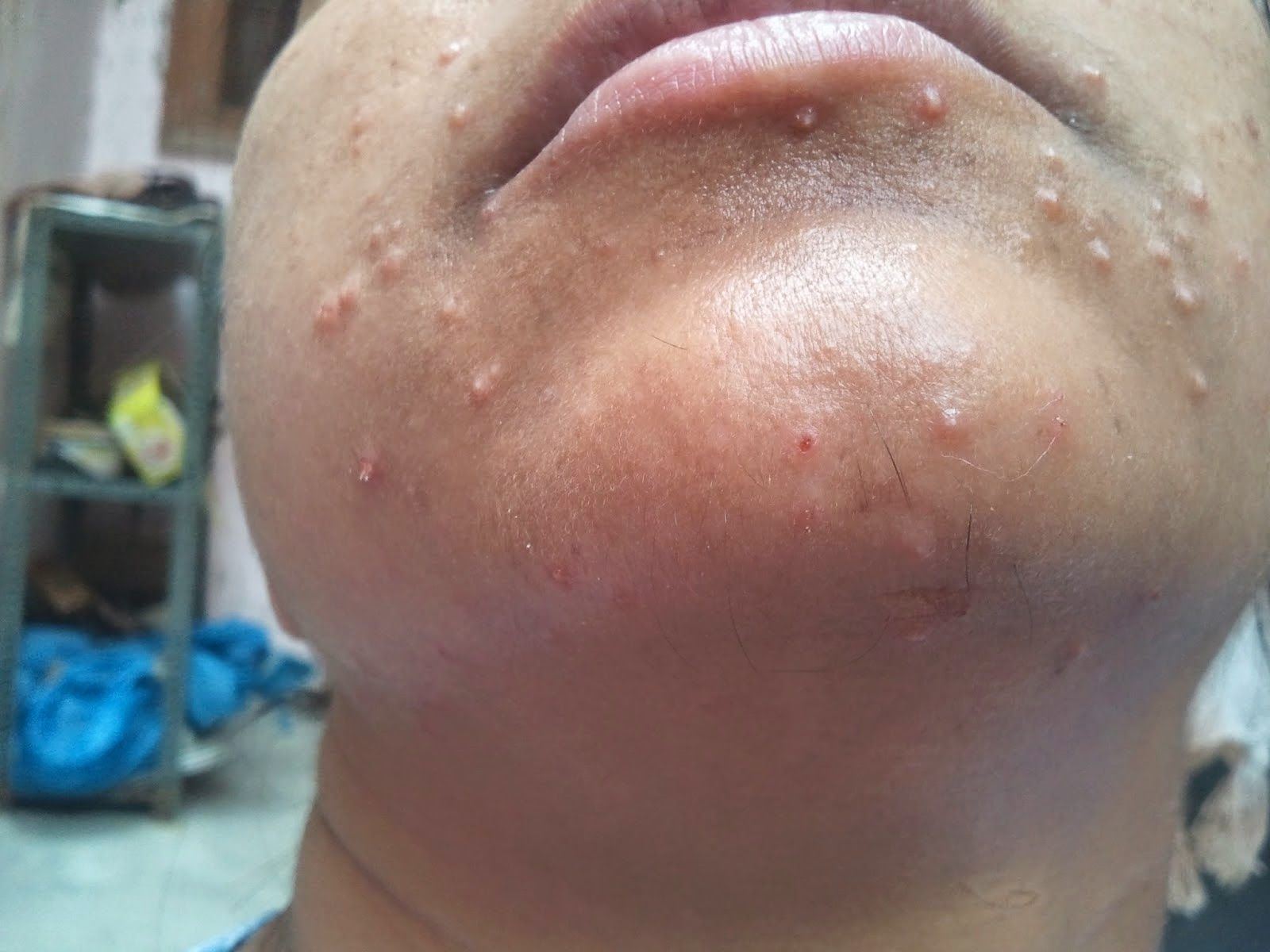 Hitch reccomend How to treat facial warts