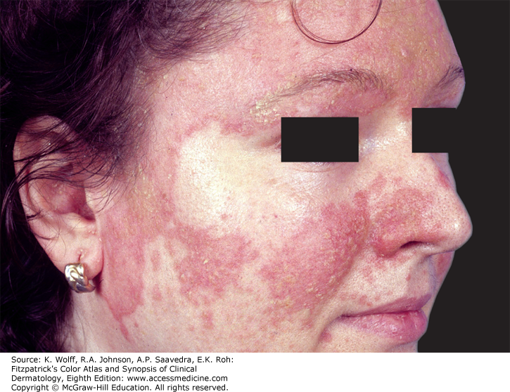 best of Dermatitis anus Seborrheic Seborrheic face dermatitis